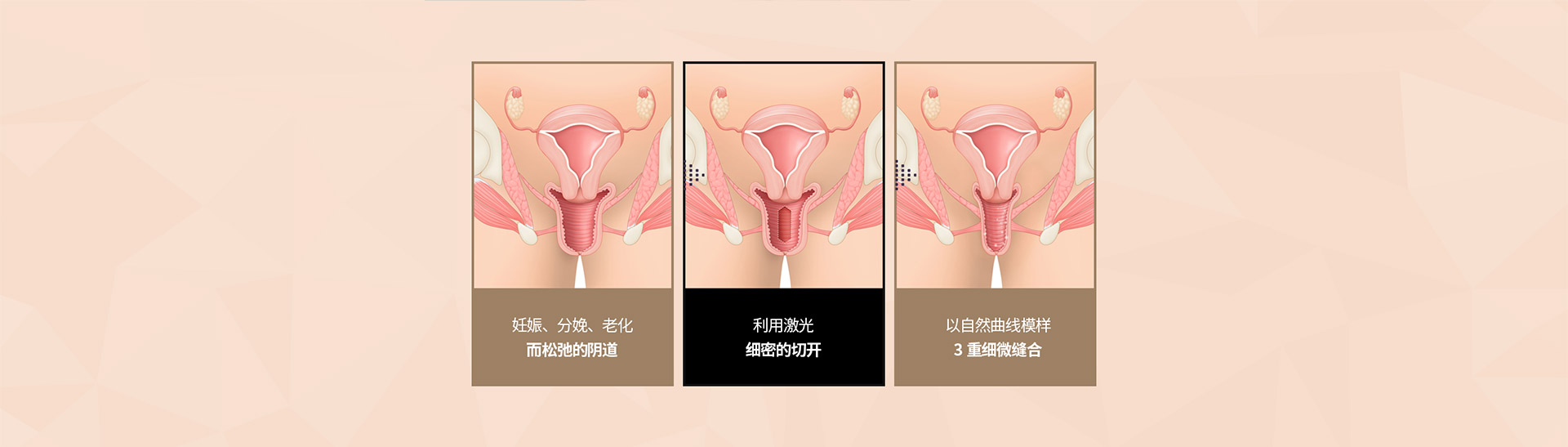 3D立体 阴道整形 시술전후
