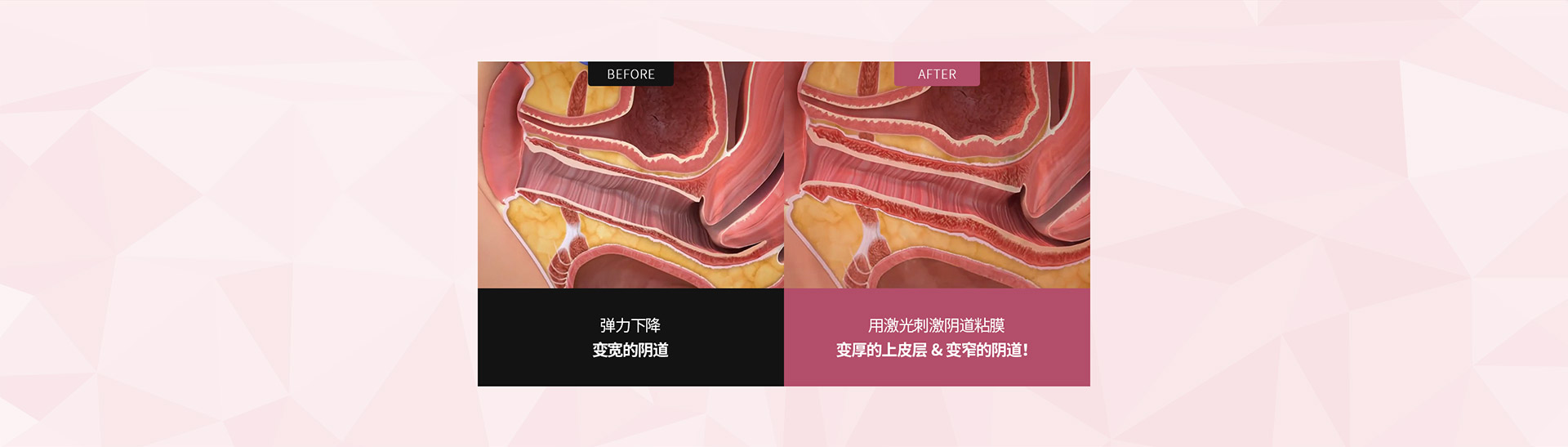 阴道缩小激光 시술전후