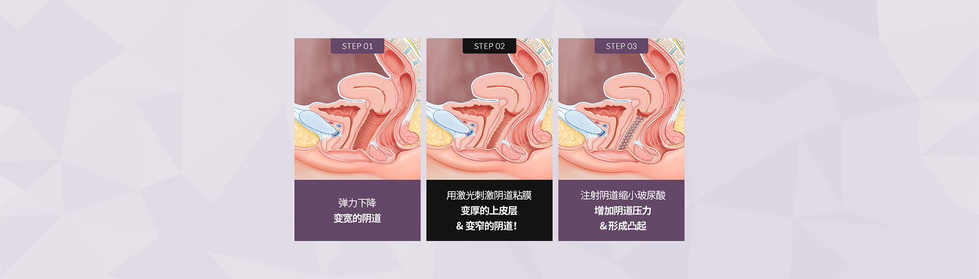 阴道缩小玻尿酸 시술전후 